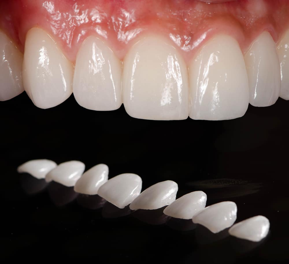 Affordable Veneers in Madera: Transform Your Smile Without the High Price Tag