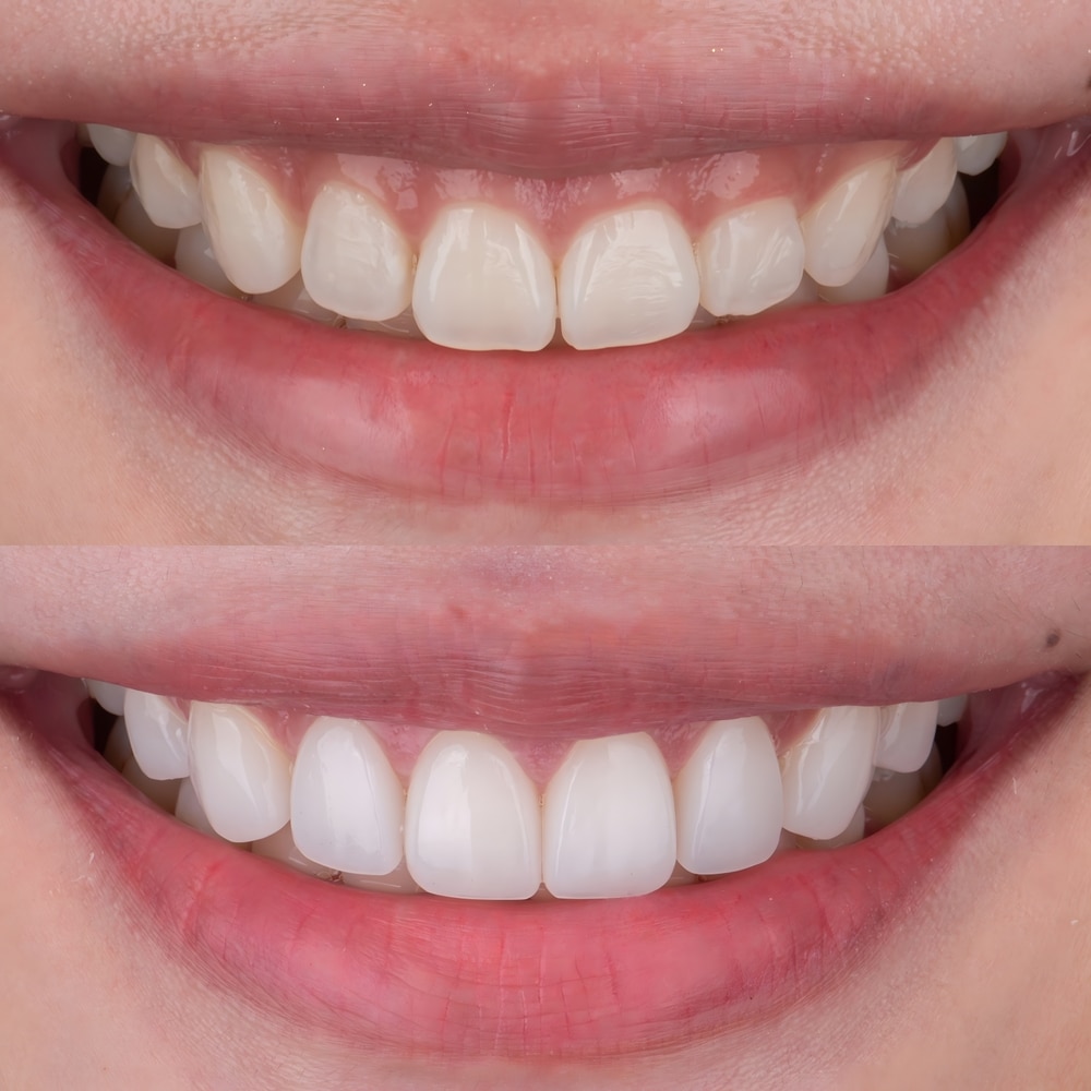 Gum Grafting Near Me: Restore Your Gumline and Protect Your Teeth