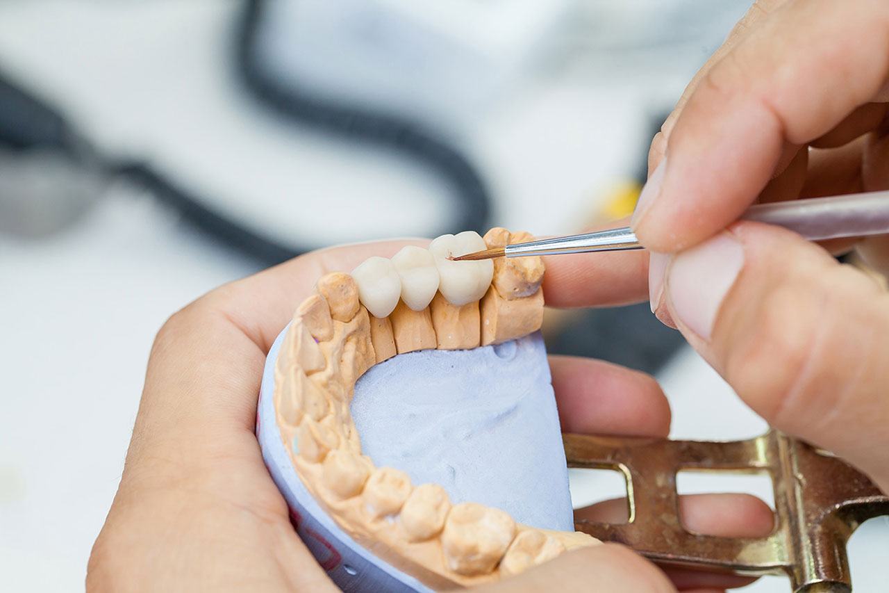 Dental Bridges for Missing Teeth: How Do They Work and Who May Be a Candidate?