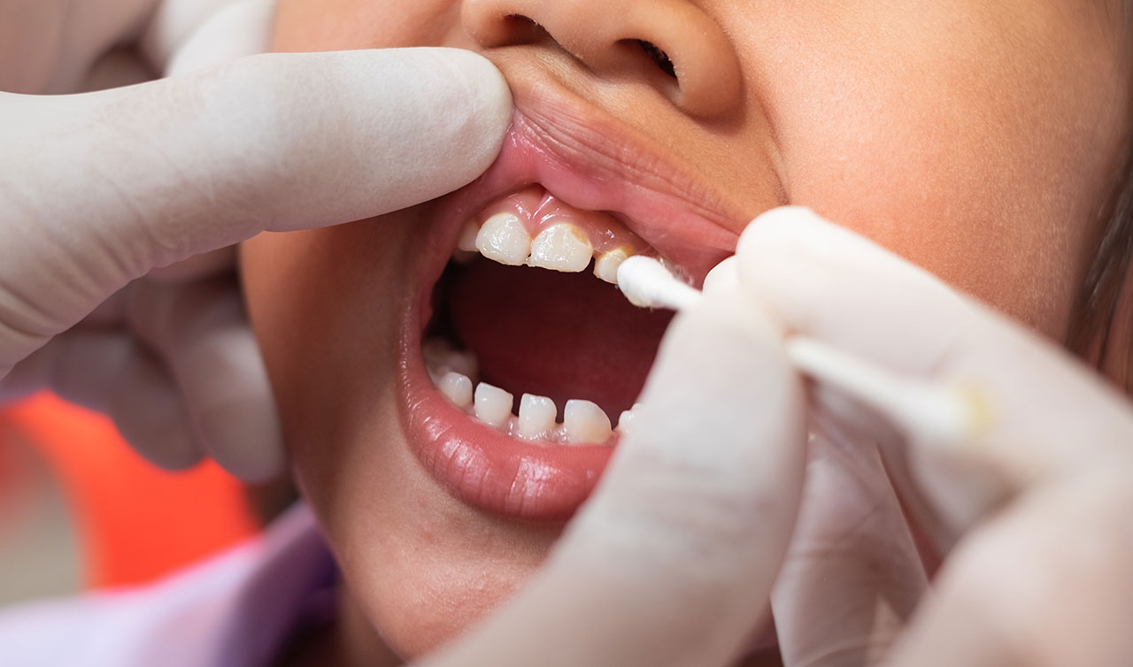 Dental Sealants for Kids and Teens: An Extra Layer of Protection Against Cavities