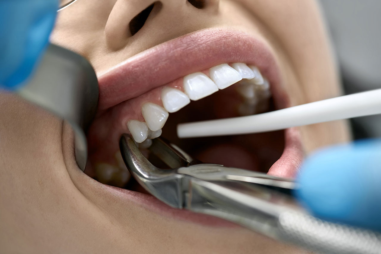 Tooth Extraction in Sanger and Madera Ranchos: When Does a Tooth Need to Be Removed?